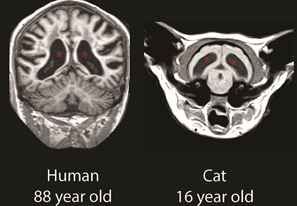 MRI ventricles